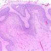5B4B Malformation (Case 5) A7 H&E 2X