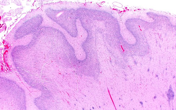 5B4B Malformation (Case 5) A7 H&E 2X