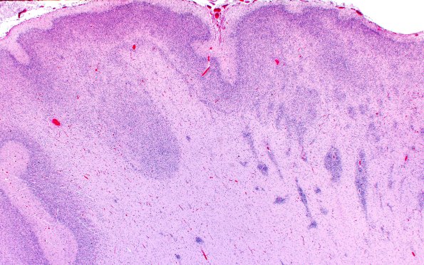 5B4C Malformation (Case 5) A7 H&E 2X 1