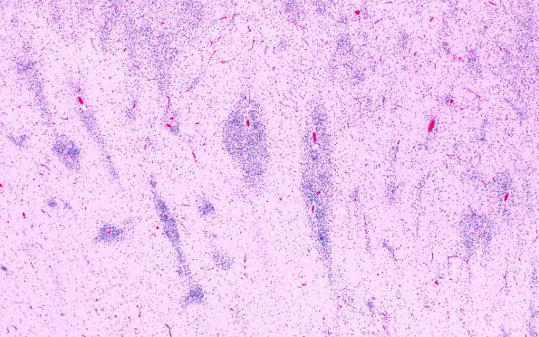 5B4E Malformation (Case 5) A7 H&E 4X 2