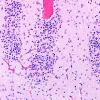 5B4F Malformation (Case 5) A7 H&E 20X
