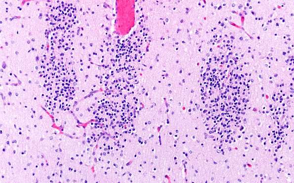 5B4F Malformation (Case 5) A7 H&E 20X