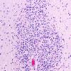5B4G Malformation (Case 5) A7 H&E 20X 2