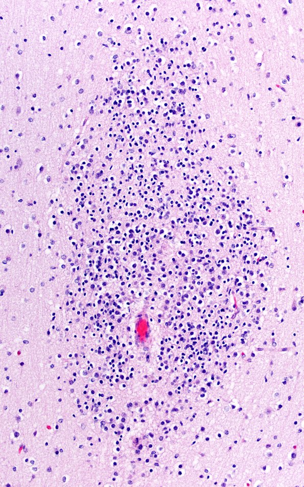 5B4G Malformation (Case 5) A7 H&E 20X 2
