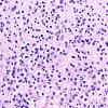 5B4H Malformation (Case 5) A7 H&E 40X 3