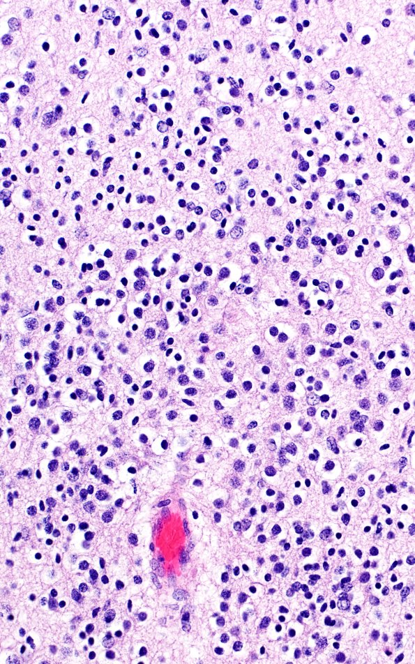 5B4H Malformation (Case 5) A7 H&E 40X 3