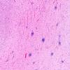 5B4J Malformation (Case 5) A7 H&E 4X