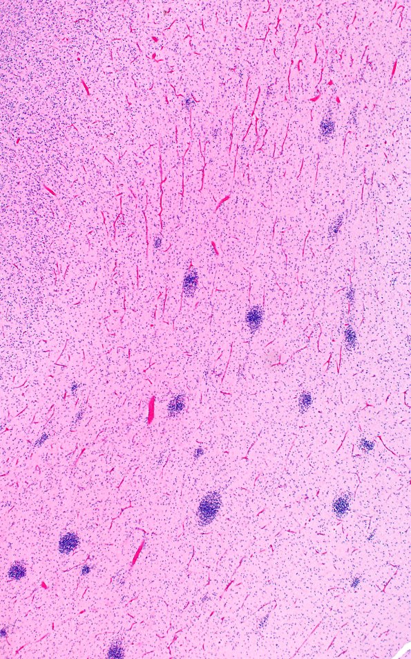 5B4J Malformation (Case 5) A7 H&E 4X