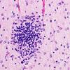 5B4K Malformation (Case 5) A7 H&E 40X