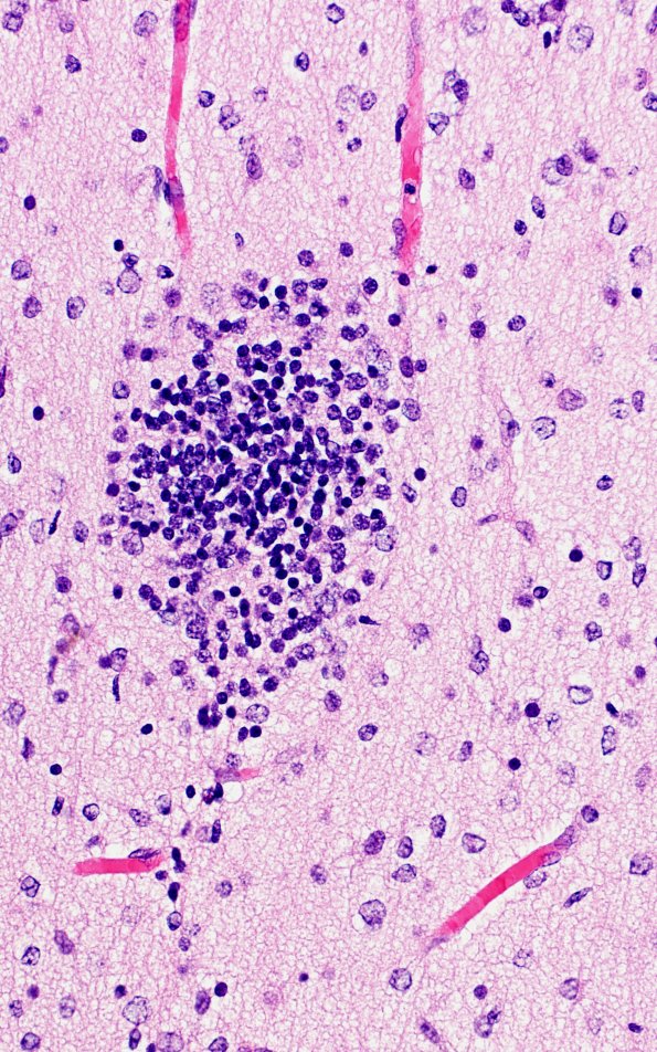 5B4K Malformation (Case 5) A7 H&E 40X