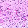 5B5 Malformation (Case 5) H&E A51 2X 3