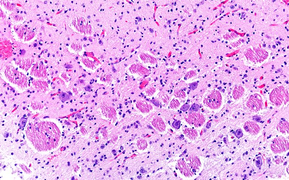 5B5 Malformation (Case 5) H&E A51 2X 3
