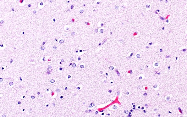 5B6 Malformation (Case 5) A7 H&E 40X 4