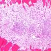 5B7B Malformation (Case 5) A7 H&E 10X 2