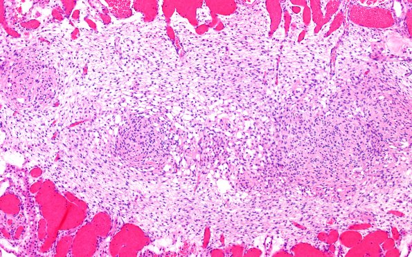 5B7B Malformation (Case 5) A7 H&E 10X 2