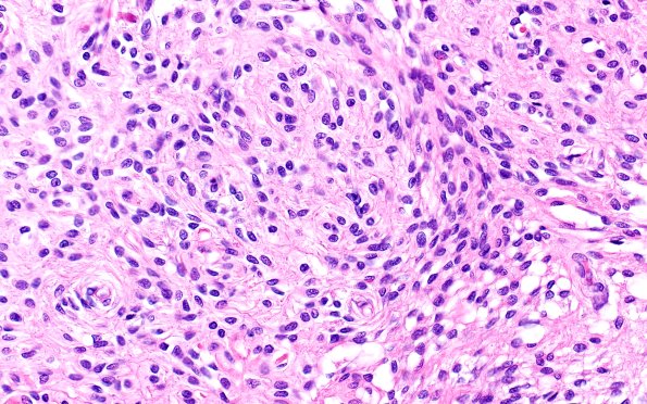 5B7C Malformation (Case 5) A7 H&E 40X 2