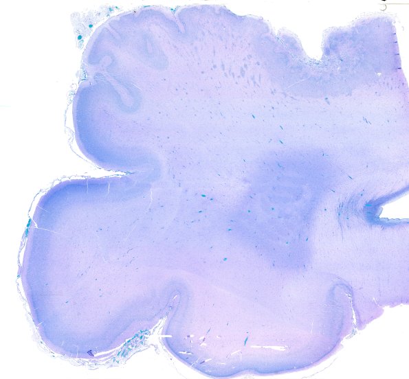 5C1 Malformation (Case 5)  LFB-PAS WM 2