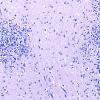 5C2 Malformation (Case 5) LFB-PAS 20X