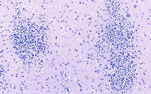 5C2 Malformation (Case 5) LFB-PAS 20X