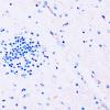 5D1 Malformation (Case 5) CD45 20X