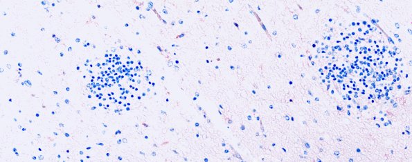 5D1 Malformation (Case 5) CD45 20X