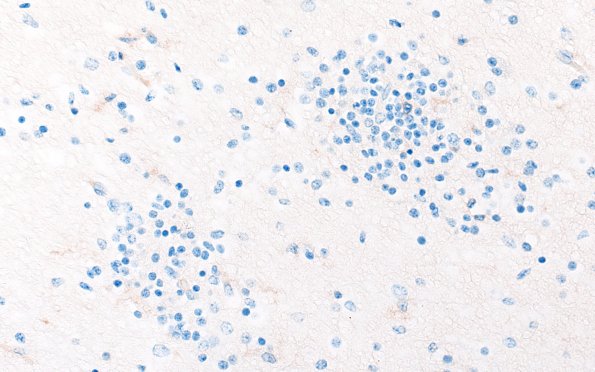5D2 Malformation (Case 5) CD45 40X