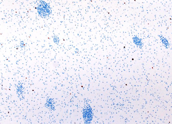 5E1 Malformation (Case 5) Ki67 10X 2