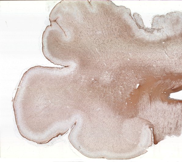 5F1 Malformation (Case 5) GFAP WM 2
