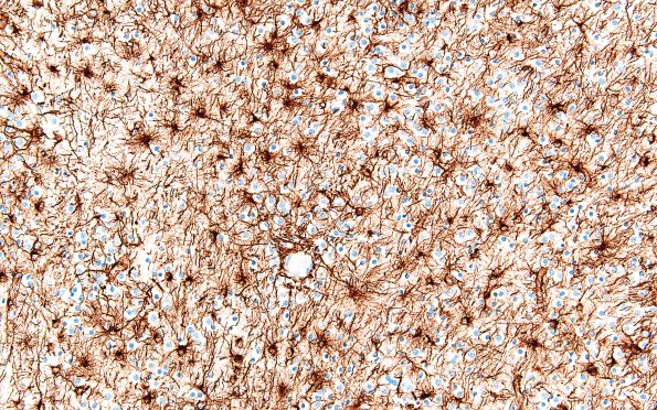 5F2 Malformation (Case 5) GFAP 20X 1