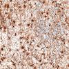 5F3 Malformation (Case 5) GFAP 20X 2