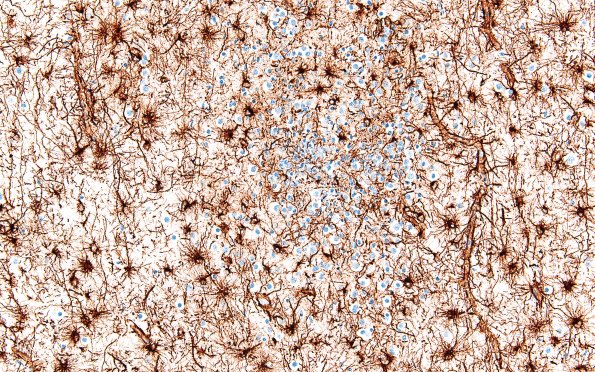 5F3 Malformation (Case 5) GFAP 20X 2