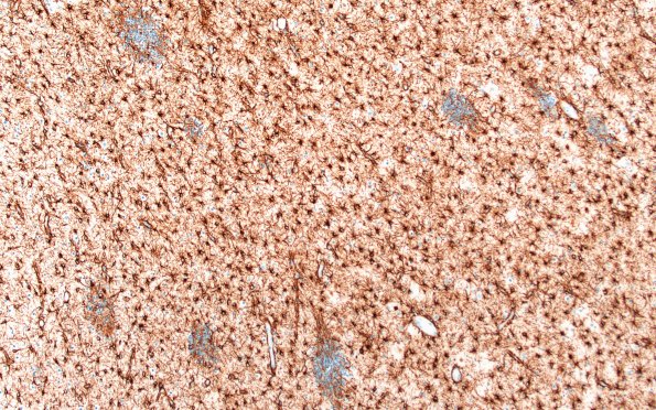 5F4 Malformation (Case 5) GFAP 10X