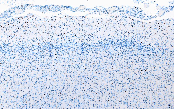 5G1 Malformation (Case 5) Olig2 10X 1