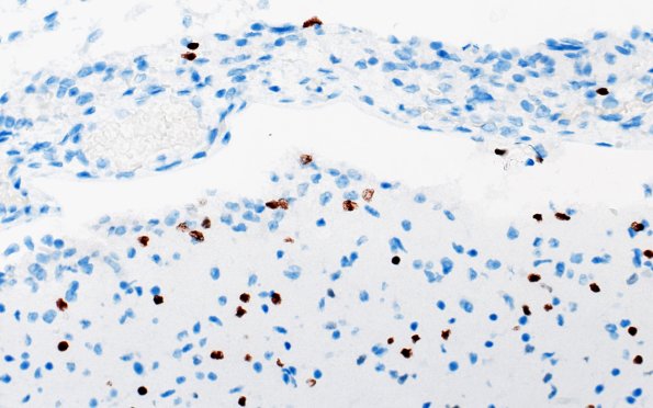 5G2 Malformation (Case 5) Olig2 40X 1