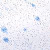 5G3 Malformation (Case 5) Olig2 10X 2