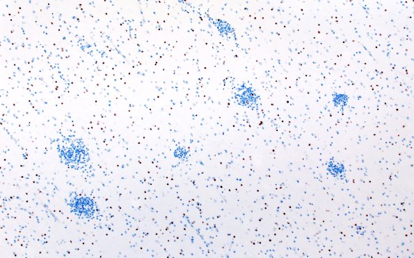 5G3 Malformation (Case 5) Olig2 10X 2