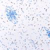5G4 Malformation (Case 5) Olig2 20X 2