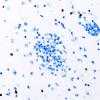 5G5 Malformation (Case 5) Olig2 40X 2