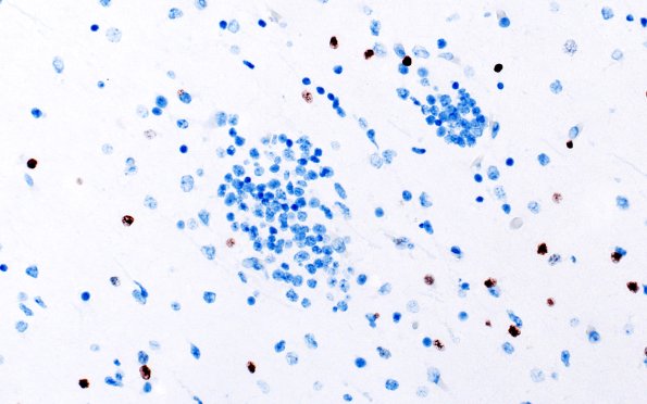 5G5 Malformation (Case 5) Olig2 40X 2