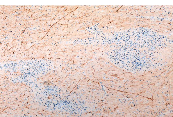 5H2 Malformation (Case 5) A7 NF 10X 1