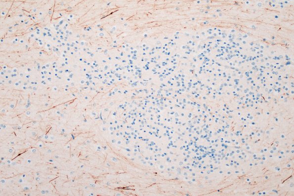 5H3 Malformation (Case 5) A7 NF 20X 1