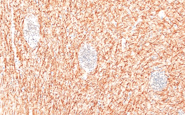 5H4 Malformation (Case 5) A7 NF 20X 2