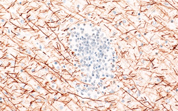 5H5 Malformation (Case 5) A7 NF 40X 1