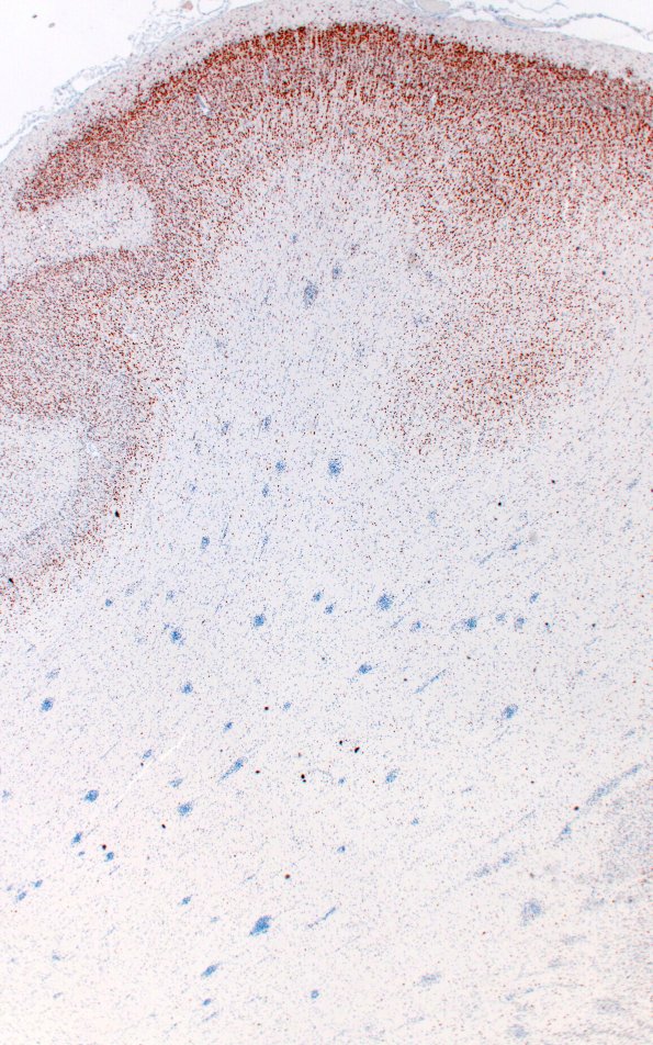 5I1 Malformation (Case 5) NeuN 2X 1