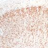 5I2 Malformation (Case 5) NeuN 10X 1