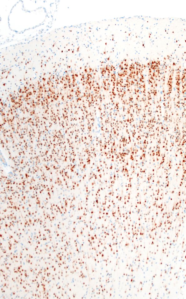 5I2 Malformation (Case 5) NeuN 10X 1
