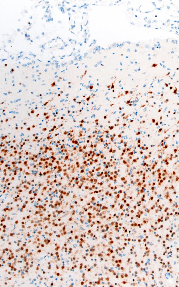 5I3 Malformation (Case 5) NeuN 20X 2