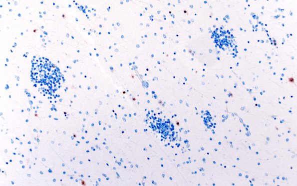 5I4 Malformation (Case 5) NeuN 20X 1