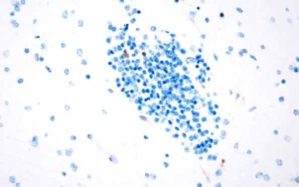 5I5 Malformation (Case 5) NeuN 40X 1