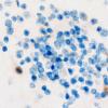 5I6 Malformation (Case 5) NeuN 100X 3